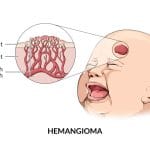 gambar hemangioma pada bayi