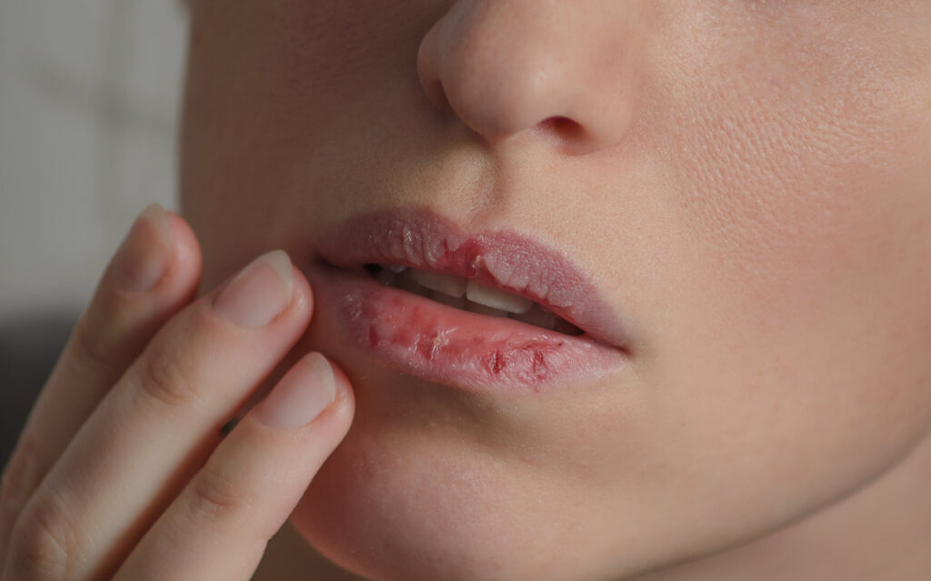 tips mengatasi bibir kering dan pecah-pecah