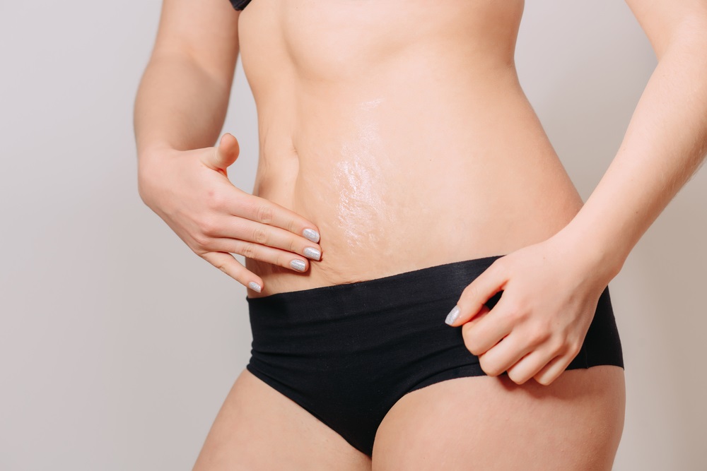 tips atasi stretch marks pada perut payudara dan paha