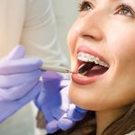 cara menjaga kesehatan kawat gigi behel